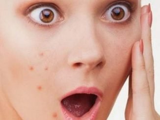 Faktor Penyebab Jerawat