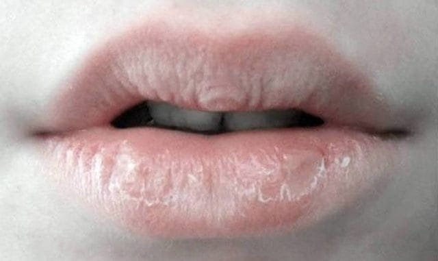 cara-mengatasi-bibir-kering (1)_640x424